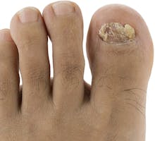 ugly toenail fungus