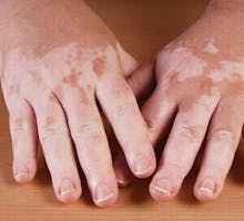 hands showing Vitiligo variation in skin pigmentation