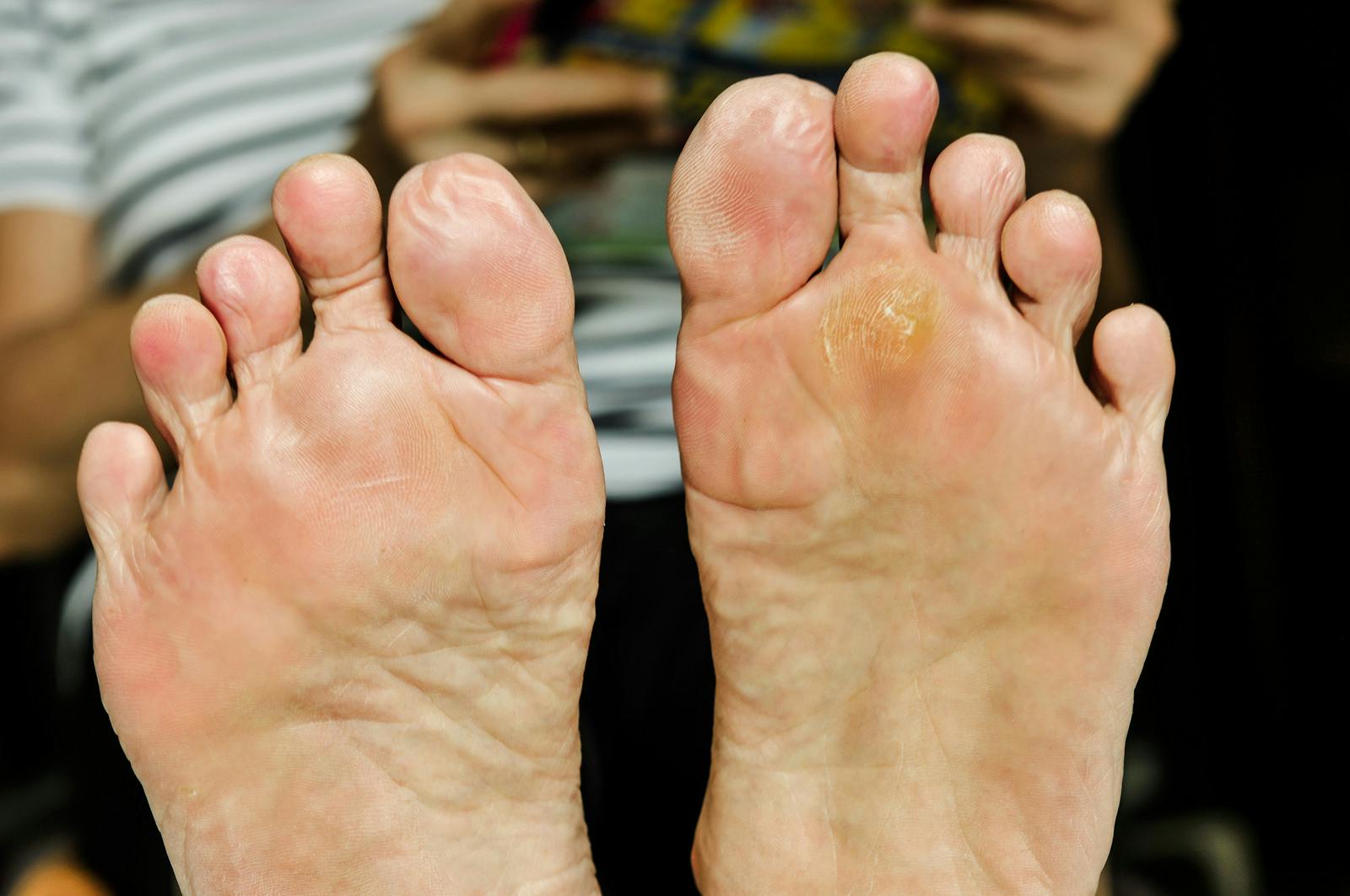 Can You Cure Warts With Vitamin A The People S Pharmacy