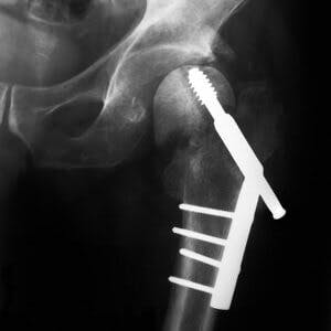 x ray of a broken hip with steel pins