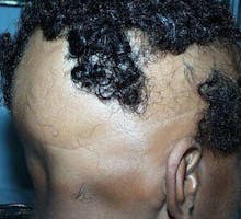 severe hair loss