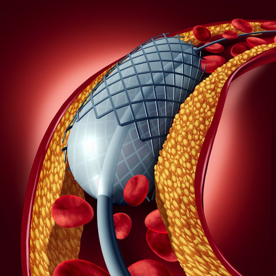 3d medical illustration of angioplasty