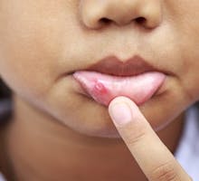 A close up of a canker sore (aphthous ulcer) on a child's lip