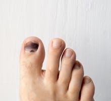 Big toe with a black nail