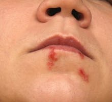 cold sores, recurrent cold sores