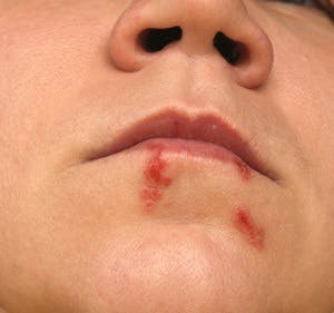 cold sores, recurrent cold sores
