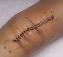 Metal staples used to stitch up skin in a knee replacement surgery operation