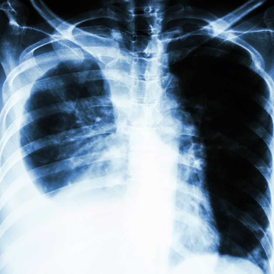 Chest X-ray showing pleural effusion at right lung due to lung cancer