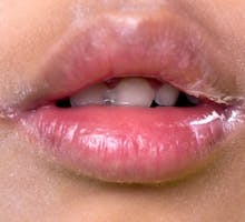 perleche or angular cheilitis, cracks in the corners of the mouth
