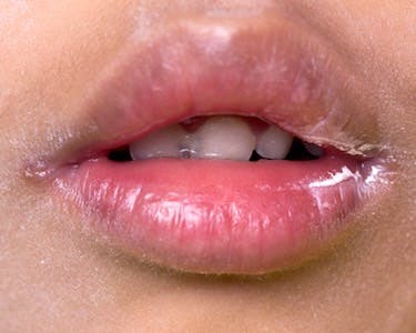 Angular Cheilitis (Perleche) Home Remedies | The People's Pharmacy Angular Cheilitis (Perleche) Home Remedies | The People's Pharmacy