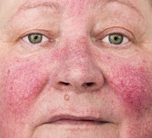 Close up of face with acne rosacea