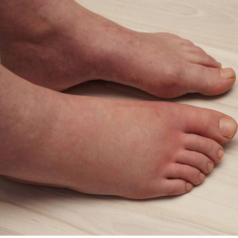 Sliced Onion Quickly Relieves Pain of a Wasp Sting | The People's Pharmacy Sliced Onion Quickly Relieves Pain of a Wasp Sting | The People's Pharmacy
